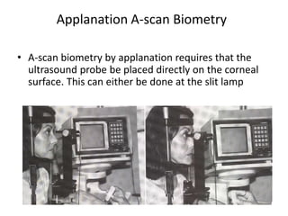 Applanation A-scan Biometry
• A-scan biometry by applanation requires that the
ultrasound probe be placed directly on the corneal
surface. This can either be done at the slit lamp
 