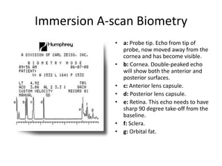 Immersion A-scan Biometry
• When the ultrasound beam is properly aligned
with the center of the macula, all five spikes wi...
