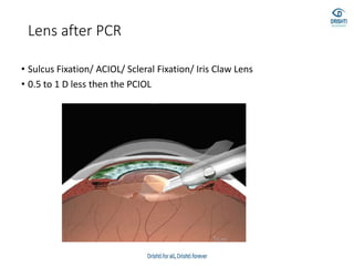Lens after PCR
• Sulcus Fixation/ ACIOL/ Scleral Fixation/ Iris Claw Lens
• 0.5 to 1 D less then the PCIOL
 