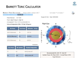 BARRETT TORIC CALCULATOR
 