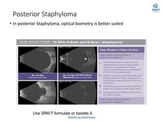 Posterior Staphyloma
• In posterior Staphyloma, optical biometry is better suited
Use SRK/T formulae or barette II
 
