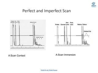 Perfect and Imperfect Scan
A Scan Contact A Scan Immersion
 
