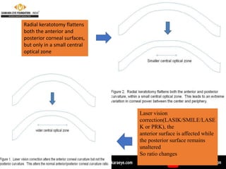Laser vision
correction(LASIK/SMILE/LASE
K or PRK), the
anterior surface is affected while
the posterior surface remains
unaltered
So ratio changes
Radial keratotomy flattens
both the anterior and
posterior corneal surfaces,
but only in a small central
optical zone
 