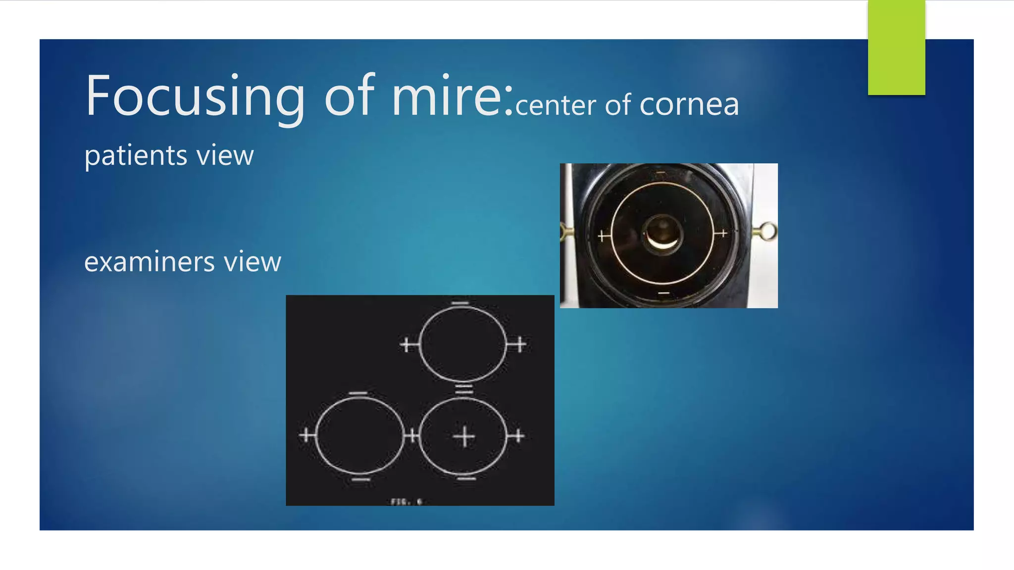 Focusing of mire:center of cornea
patients view
examiners view
 