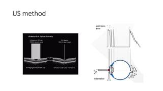 US method
Regarding axial length: Unlike A-scan ultrasound, which reflects off the surface
of the retina, the IOLMaster beam passes through the translucent surface of
the retina and back further to the more opaque pigment layer. The computer
corrects for this difference, but because everyone has different tissue thick-
nesses, results from the IOLMaster and immersion ultrasound may be slightly
different.
In addition, the use of contact ultrasound will indent the cornea, thus decreas-
ing the distance between the cornea and the retina and artificially shortening
the axial length measured. Because of this, axial lengths measured on the IOL-
Master are almost always longer than those obtained through contact ultra-
sound.
Regarding corneal curvature: First, manual keratometry measures the corneal
curvature more peripherally—perhaps at 3.0 mm or 3.2 mm, depending on
your manual system—while the IOLMaster measures the more relevant central
curvature at 2.5 mm. Thus on a typical eye, IOLMaster K’s will be slightly
 