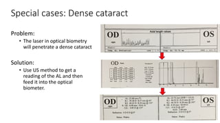 Special cases: Dense cataract
Problem:
• The laser in optical biometry
will penetrate a dense cataract
Solution:
• Use US method to get a
reading of the AL and then
feed it into the optical
biometer.
 