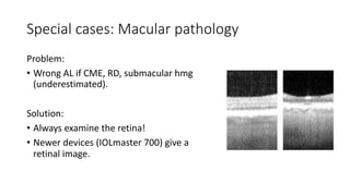 Special cases: Macular pathology
Problem:
• Wrong AL if CME, RD, submacular hmg
(underestimated).
Solution:
• Always examine the retina!
• Newer devices (IOLmaster 700) give a
retinal image.
 