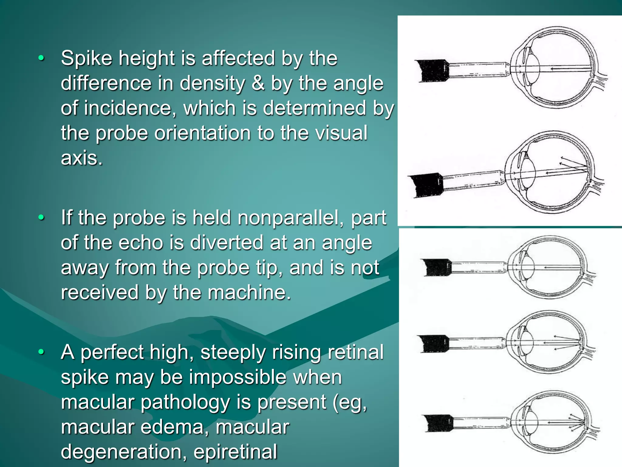 • Spike height is affected by the 
difference in density & by the angle 
of incidence, which is determined by 
the probe orientation to the visual 
axis. 
• If the probe is held nonparallel, part 
of the echo is diverted at an angle 
away from the probe tip, and is not 
received by the machine. 
• A perfect high, steeply rising retinal 
spike may be impossible when 
macular pathology is present (eg, 
macular edema, macular 
degeneration, epiretinal 
 