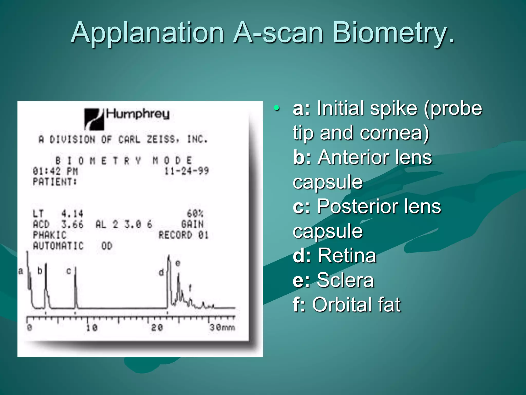 Applanation A-scan Biometry. 
• a: Initial spike (probe 
tip and cornea) 
b: Anterior lens 
capsule 
c: Posterior lens 
capsule 
d: Retina 
e: Sclera 
f: Orbital fat 
 
