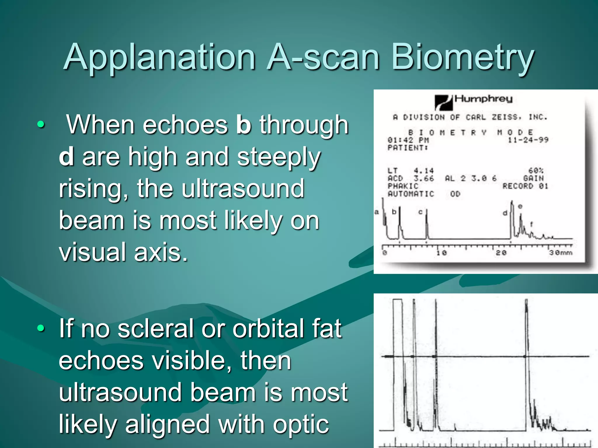 Applanation A-scan Biometry 
• When echoes b through 
d are high and steeply 
rising, the ultrasound 
beam is most likely on 
visual axis. 
• If no scleral or orbital fat 
echoes visible, then 
ultrasound beam is most 
likely aligned with optic 
nerve. 
 