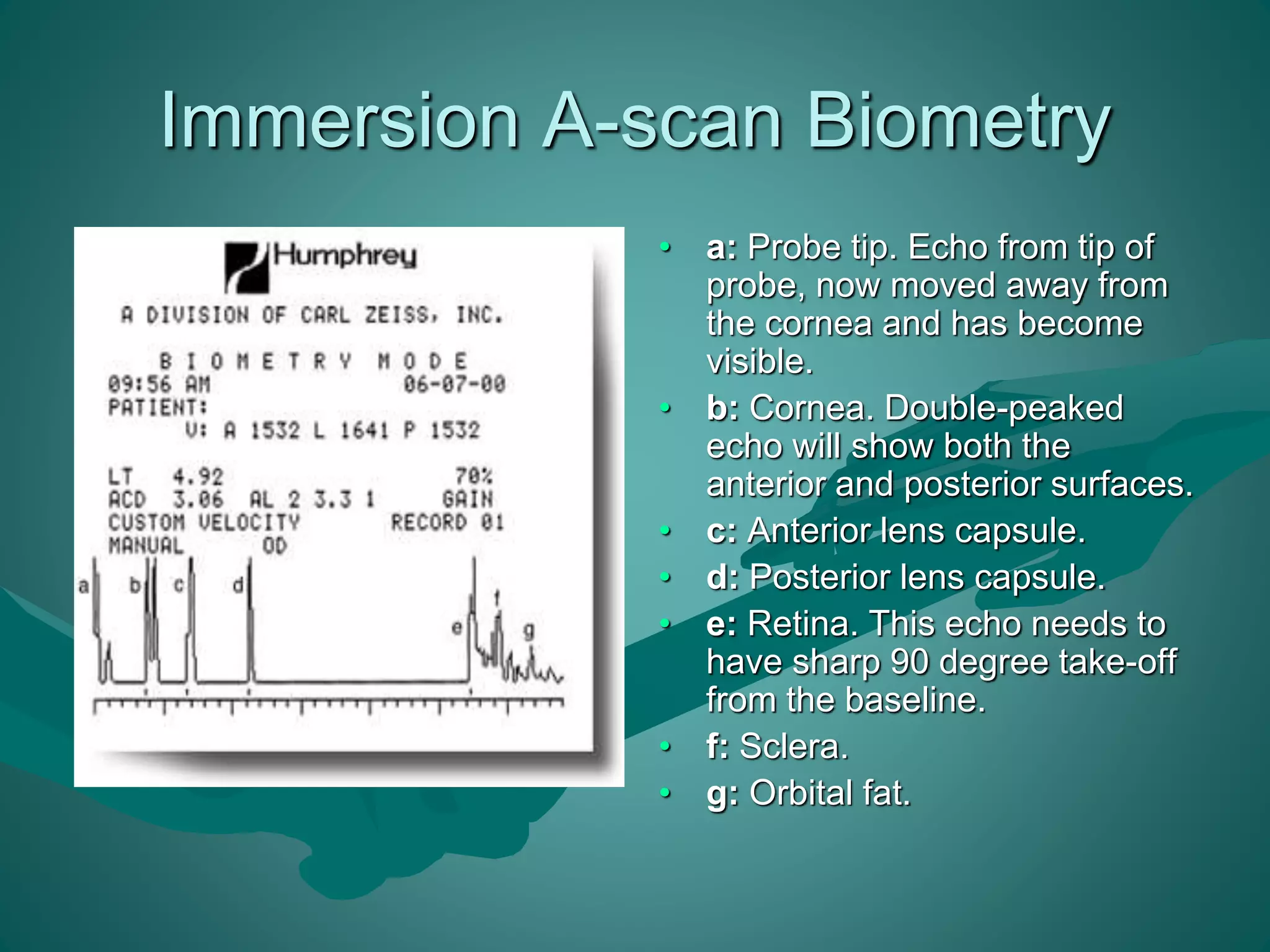 Immersion A-scan Biometry 
• . • a: Probe tip. Echo from tip of 
probe, now moved away from 
the cornea and has become 
visible. 
• b: Cornea. Double-peaked 
echo will show both the 
anterior and posterior surfaces. 
• c: Anterior lens capsule. 
• d: Posterior lens capsule. 
• e: Retina. This echo needs to 
have sharp 90 degree take-off 
from the baseline. 
• f: Sclera. 
• g: Orbital fat. 
 