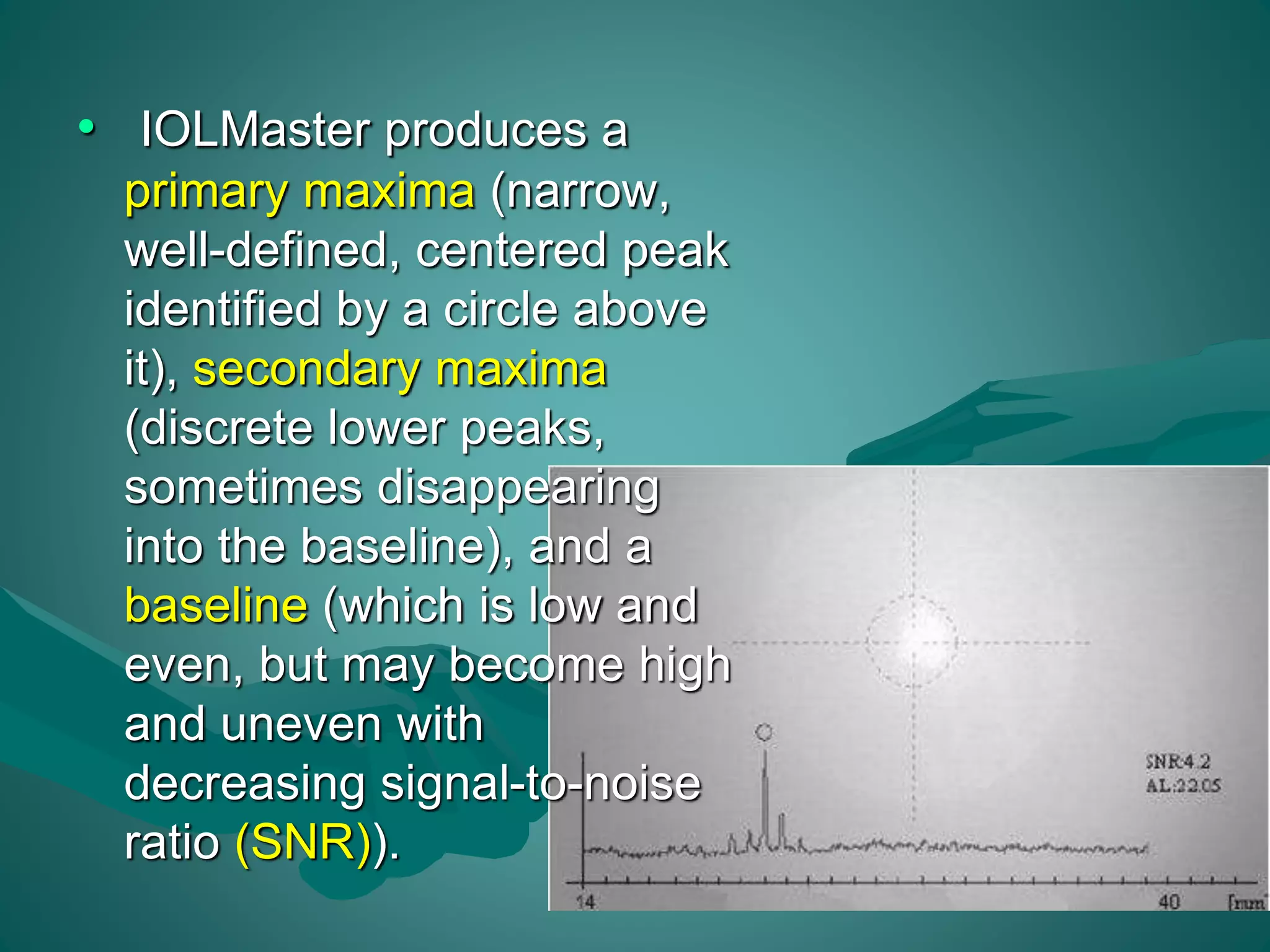 • IOLMaster produces a 
primary maxima (narrow, 
well-defined, centered peak 
identified by a circle above 
it), secondary maxima 
(discrete lower peaks, 
sometimes disappearing 
into the baseline), and a 
baseline (which is low and 
even, but may become high 
and uneven with 
decreasing signal-to-noise 
ratio (SNR)). 
 