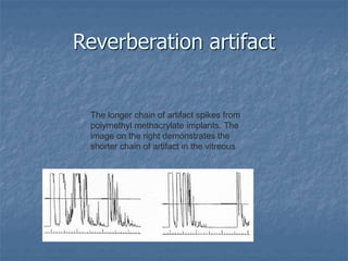 Reverberation artifact
The longer chain of artifact spikes from
polymethyl methacrylate implants. The
image on the right demonstrates the
shorter chain of artifact in the vitreous
 