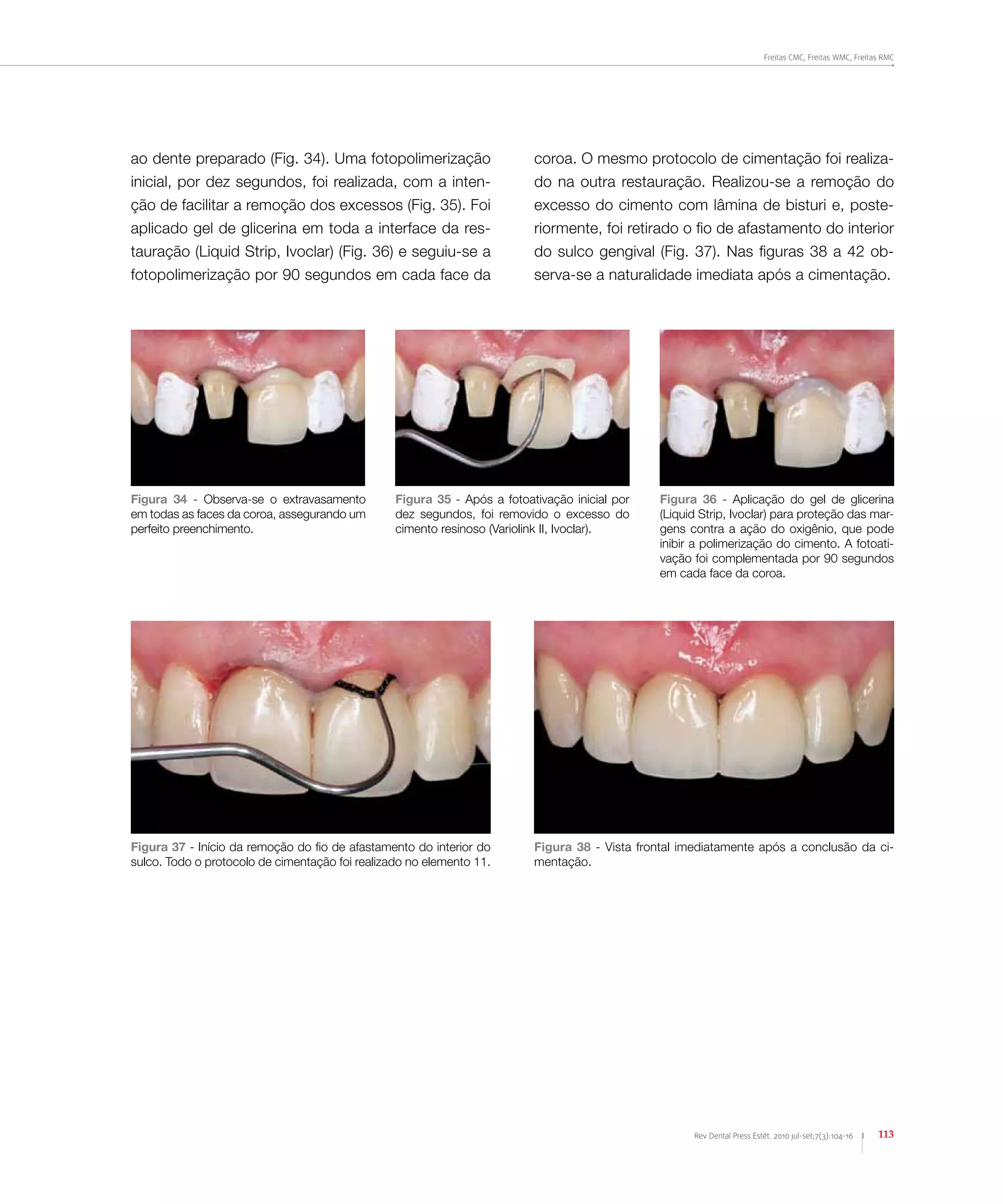 Freitas CMC, Freitas WMC, Freitas RMC
113Rev Dental Press Estét. 2010 jul-set;7(3):104-16
Figura 34 - Observa-se o extravasamento
em todas as faces da coroa, assegurando um
perfeito preenchimento.
Figura 35 - Após a fotoativação inicial por
dez segundos, foi removido o excesso do
cimento resinoso (Variolink II, Ivoclar).
Figura 36 - Aplicação do gel de glicerina
(Liquid Strip, Ivoclar) para proteção das mar-
gens contra a ação do oxigênio, que pode
inibir a polimerização do cimento. A fotoati-
vação foi complementada por 90 segundos
em cada face da coroa.
ao dente preparado (Fig. 34). Uma fotopolimerização
inicial, por dez segundos, foi realizada, com a inten-
ção de facilitar a remoção dos excessos (Fig. 35). Foi
aplicado gel de glicerina em toda a interface da res-
tauração (Liquid Strip, Ivoclar) (Fig. 36) e seguiu-se a
fotopolimerização por 90 segundos em cada face da
coroa. O mesmo protocolo de cimentação foi realiza-
do na outra restauração. Realizou-se a remoção do
excesso do cimento com lâmina de bisturi e, poste-
riormente, foi retirado o fio de afastamento do interior
do sulco gengival (Fig. 37). Nas figuras 38 a 42 ob-
serva-se a naturalidade imediata após a cimentação.
Figura 37 - Início da remoção do fio de afastamento do interior do
sulco. Todo o protocolo de cimentação foi realizado no elemento 11.
Figura 38 - Vista frontal imediatamente após a conclusão da ci-
mentação.
 