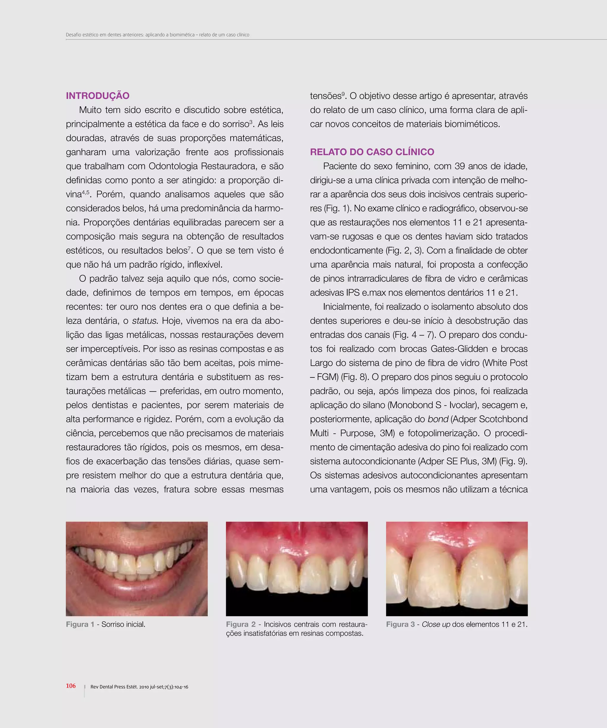Desafio estético em dentes anteriores: aplicando a biomimética – relato de um caso clínico
106 Rev Dental Press Estét. 2010 jul-set;7(3):104-16
INTRODUÇÃO
Muito tem sido escrito e discutido sobre estética,
principalmente a estética da face e do sorriso3
. As leis
douradas, através de suas proporções matemáticas,
ganharam uma valorização frente aos profissionais
que trabalham com Odontologia Restauradora, e são
definidas como ponto a ser atingido: a proporção di-
vina4,5
. Porém, quando analisamos aqueles que são
considerados belos, há uma predominância da harmo-
nia. Proporções dentárias equilibradas parecem ser a
composição mais segura na obtenção de resultados
estéticos, ou resultados belos7
. O que se tem visto é
que não há um padrão rígido, inflexível.
O padrão talvez seja aquilo que nós, como socie-
dade, definimos de tempos em tempos, em épocas
recentes: ter ouro nos dentes era o que definia a be-
leza dentária, o status. Hoje, vivemos na era da abo-
lição das ligas metálicas, nossas restaurações devem
ser imperceptíveis. Por isso as resinas compostas e as
cerâmicas dentárias são tão bem aceitas, pois mime-
tizam bem a estrutura dentária e substituem as res-
taurações metálicas — preferidas, em outro momento,
pelos dentistas e pacientes, por serem materiais de
alta performance e rigidez. Porém, com a evolução da
ciência, percebemos que não precisamos de materiais
restauradores tão rígidos, pois os mesmos, em desa-
fios de exacerbação das tensões diárias, quase sem-
pre resistem melhor do que a estrutura dentária que,
na maioria das vezes, fratura sobre essas mesmas
tensões9
. O objetivo desse artigo é apresentar, através
do relato de um caso clínico, uma forma clara de apli-
car novos conceitos de materiais biomiméticos.
Relato do caso clínico
Paciente do sexo feminino, com 39 anos de idade,
dirigiu-se a uma clínica privada com intenção de melho-
rar a aparência dos seus dois incisivos centrais superio-
res (Fig. 1). No exame clínico e radiográfico, observou-se
que as restaurações nos elementos 11 e 21 apresenta-
vam-se rugosas e que os dentes haviam sido tratados
endodonticamente (Fig. 2, 3). Com a finalidade de obter
uma aparência mais natural, foi proposta a confecção
de pinos intrarradiculares de fibra de vidro e cerâmicas
adesivas IPS e.max nos elementos dentários 11 e 21.
Inicialmente, foi realizado o isolamento absoluto dos
dentes superiores e deu-se início à desobstrução das
entradas dos canais (Fig. 4 – 7). O preparo dos condu-
tos foi realizado com brocas Gates-Glidden e brocas
Largo do sistema de pino de fibra de vidro (White Post
– FGM) (Fig. 8). O preparo dos pinos seguiu o protocolo
padrão, ou seja, após limpeza dos pinos, foi realizada
aplicação do silano (Monobond S - Ivoclar), secagem e,
posteriormente, aplicação do bond (Adper Scotchbond
Multi - Purpose, 3M) e fotopolimerização. O procedi-
mento de cimentação adesiva do pino foi realizado com
sistema autocondicionante (Adper SE Plus, 3M) (Fig. 9).
Os sistemas adesivos autocondicionantes apresentam
uma vantagem, pois os mesmos não utilizam a técnica
Figura 1 - Sorriso inicial. Figura 2 - Incisivos centrais com restaura-
ções insatisfatórias em resinas compostas.
Figura 3 - Close up dos elementos 11 e 21.
 