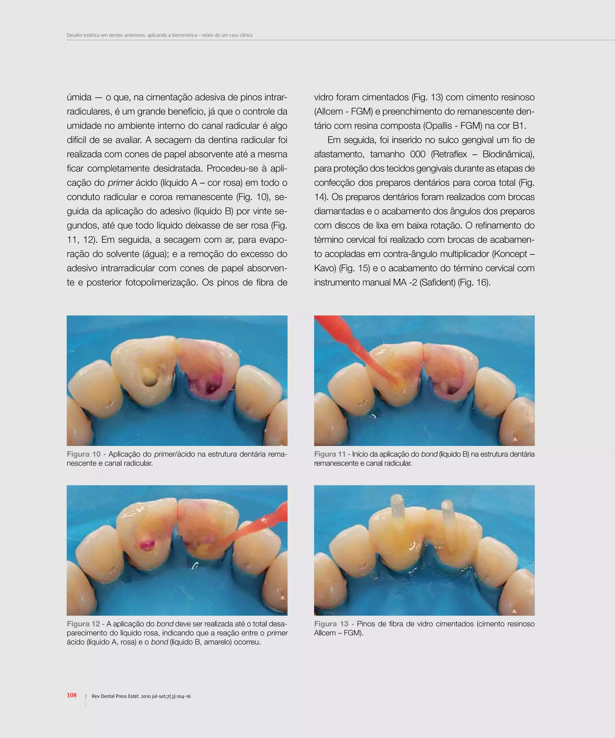 Desafio estético em dentes anteriores: aplicando a biomimética – relato de um caso clínico
108 Rev Dental Press Estét. 2010 jul-set;7(3):104-16
úmida — o que, na cimentação adesiva de pinos intrar-
radiculares, é um grande benefício, já que o controle da
umidade no ambiente interno do canal radicular é algo
difícil de se avaliar. A secagem da dentina radicular foi
realizada com cones de papel absorvente até a mesma
ficar completamente desidratada. Procedeu-se à apli-
cação do primer ácido (líquido A – cor rosa) em todo o
conduto radicular e coroa remanescente (Fig. 10), se-
guida da aplicação do adesivo (líquido B) por vinte se-
gundos, até que todo líquido deixasse de ser rosa (Fig.
11, 12). Em seguida, a secagem com ar, para evapo-
ração do solvente (água); e a remoção do excesso do
adesivo intrarradicular com cones de papel absorven-
te e posterior fotopolimerização. Os pinos de fibra de
vidro foram cimentados (Fig. 13) com cimento resinoso
(Allcem - FGM) e preenchimento do remanescente den-
tário com resina composta (Opallis - FGM) na cor B1.
Em seguida, foi inserido no sulco gengival um fio de
afastamento, tamanho 000 (Retraflex – Biodinâmica),
para proteção dos tecidos gengivais durante as etapas de
confecção dos preparos dentários para coroa total (Fig.
14). Os preparos dentários foram realizados com brocas
diamantadas e o acabamento dos ângulos dos preparos
com discos de lixa em baixa rotação. O refinamento do
término cervical foi realizado com brocas de acabamen-
to acopladas em contra-ângulo multiplicador (Koncept –
Kavo) (Fig. 15) e o acabamento do término cervical com
instrumento manual MA -2 (Safident) (Fig. 16).
Figura 10 - Aplicação do primer/ácido na estrutura dentária rema-
nescente e canal radicular.
Figura 11 - Início da aplicação do bond (líquido B) na estrutura dentária
remanescente e canal radicular.
Figura 12 - A aplicação do bond deve ser realizada até o total desa-
parecimento do líquido rosa, indicando que a reação entre o primer
ácido (líquido A, rosa) e o bond (líquido B, amarelo) ocorreu.
Figura 13 - Pinos de fibra de vidro cimentados (cimento resinoso
Allcem – FGM).
 