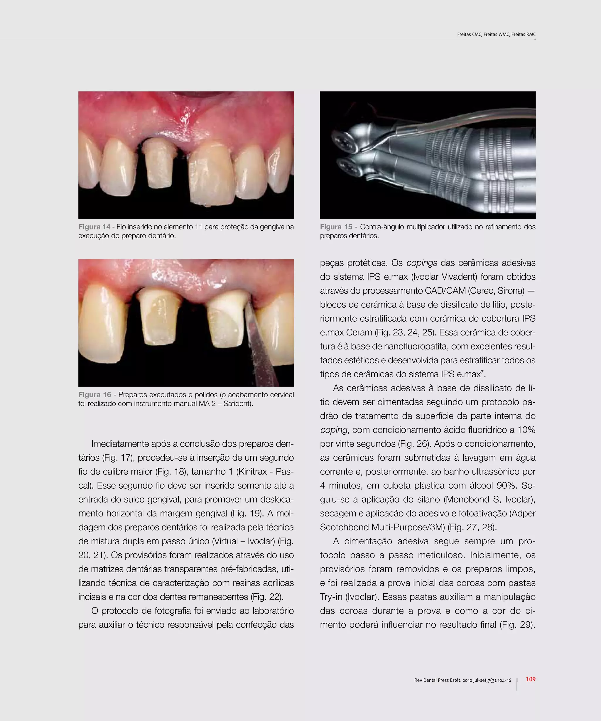 Freitas CMC, Freitas WMC, Freitas RMC
109Rev Dental Press Estét. 2010 jul-set;7(3):104-16
Figura 14 - Fio inserido no elemento 11 para proteção da gengiva na
execução do preparo dentário.
Figura 15 - Contra-ângulo multiplicador utilizado no refinamento dos
preparos dentários.
Figura 16 - Preparos executados e polidos (o acabamento cervical
foi realizado com instrumento manual MA 2 – Safident).
Imediatamente após a conclusão dos preparos den-
tários (Fig. 17), procedeu-se à inserção de um segundo
fio de calibre maior (Fig. 18), tamanho 1 (Kinitrax - Pas-
cal). Esse segundo fio deve ser inserido somente até a
entrada do sulco gengival, para promover um desloca-
mento horizontal da margem gengival (Fig. 19). A mol-
dagem dos preparos dentários foi realizada pela técnica
de mistura dupla em passo único (Virtual – Ivoclar) (Fig.
20, 21). Os provisórios foram realizados através do uso
de matrizes dentárias transparentes pré-fabricadas, uti-
lizando técnica de caracterização com resinas acrílicas
incisais e na cor dos dentes remanescentes (Fig. 22).
O protocolo de fotografia foi enviado ao laboratório
para auxiliar o técnico responsável pela confecção das
peças protéticas. Os copings das cerâmicas adesivas
do sistema IPS e.max (Ivoclar Vivadent) foram obtidos
através do processamento CAD/CAM (Cerec, Sirona) —
blocos de cerâmica à base de dissilicato de lítio, poste-
riormente estratificada com cerâmica de cobertura IPS
e.max Ceram (Fig. 23, 24, 25). Essa cerâmica de cober-
tura é à base de nanofluoropatita, com excelentes resul-
tados estéticos e desenvolvida para estratificar todos os
tipos de cerâmicas do sistema IPS e.max7
.
As cerâmicas adesivas à base de dissilicato de lí-
tio devem ser cimentadas seguindo um protocolo pa-
drão de tratamento da superfície da parte interna do
coping, com condicionamento ácido fluorídrico a 10%
por vinte segundos (Fig. 26). Após o condicionamento,
as cerâmicas foram submetidas à lavagem em água
corrente e, posteriormente, ao banho ultrassônico por
4 minutos, em cubeta plástica com álcool 90%. Se-
guiu-se a aplicação do silano (Monobond S, Ivoclar),
secagem e aplicação do adesivo e fotoativação (Adper
Scotchbond Multi-Purpose/3M) (Fig. 27, 28).
A cimentação adesiva segue sempre um pro-
tocolo passo a passo meticuloso. Inicialmente, os
provisórios foram removidos e os preparos limpos,
e foi realizada a prova inicial das coroas com pastas
Try-in (Ivoclar). Essas pastas auxiliam a manipulação
das coroas durante a prova e como a cor do ci-
mento poderá influenciar no resultado final (Fig. 29).
 