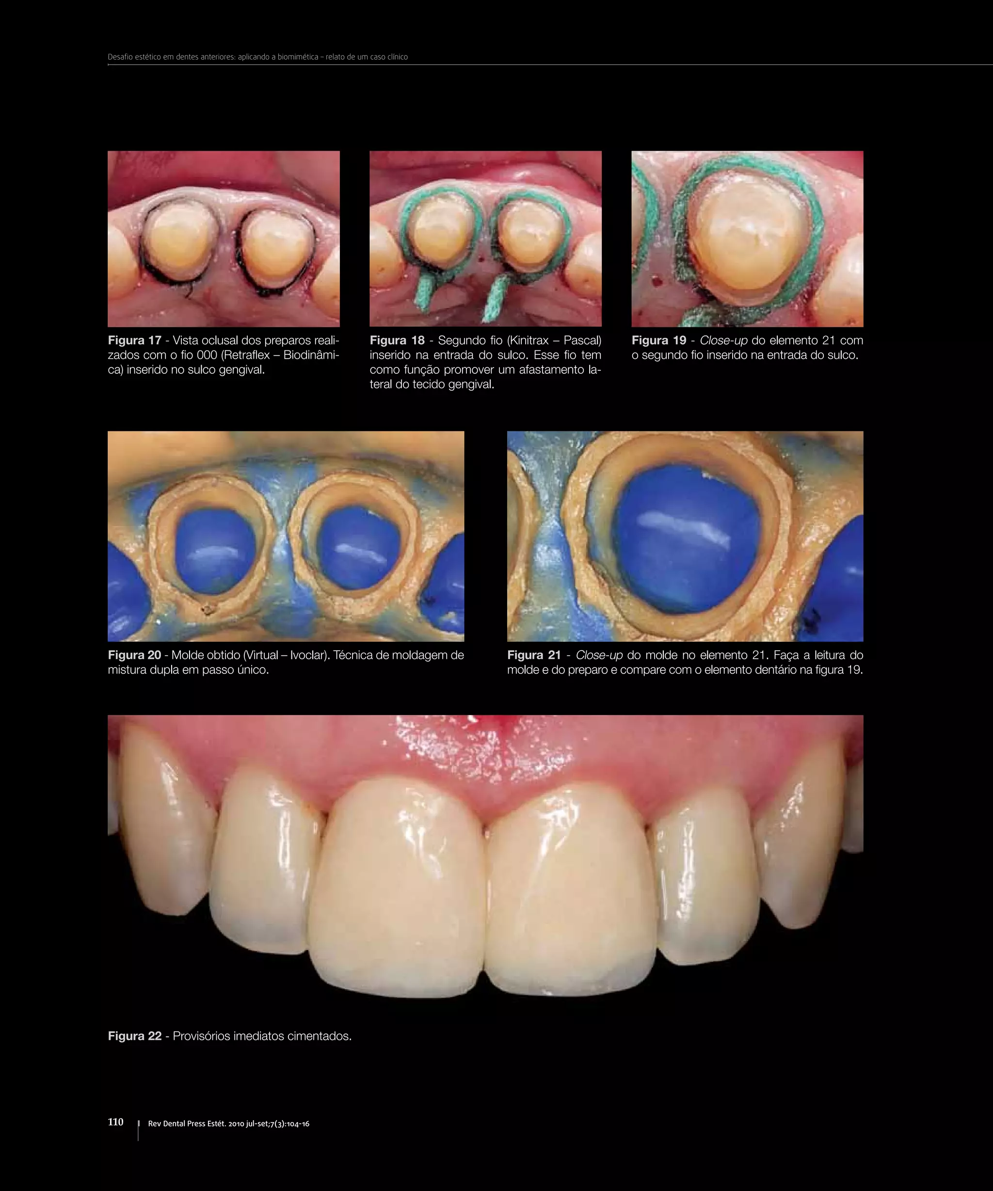 Desafio estético em dentes anteriores: aplicando a biomimética – relato de um caso clínico
110 Rev Dental Press Estét. 2010 jul-set;7(3):104-16
Figura 17 - Vista oclusal dos preparos reali-
zados com o fio 000 (Retraflex – Biodinâmi-
ca) inserido no sulco gengival.
Figura 18 - Segundo fio (Kinitrax – Pascal)
inserido na entrada do sulco. Esse fio tem
como função promover um afastamento la-
teral do tecido gengival.
Figura 19 - Close-up do elemento 21 com
o segundo fio inserido na entrada do sulco.
Figura 20 - Molde obtido (Virtual – Ivoclar). Técnica de moldagem de
mistura dupla em passo único.
Figura 22 - Provisórios imediatos cimentados.
Figura 21 - Close-up do molde no elemento 21. Faça a leitura do
molde e do preparo e compare com o elemento dentário na figura 19.
 