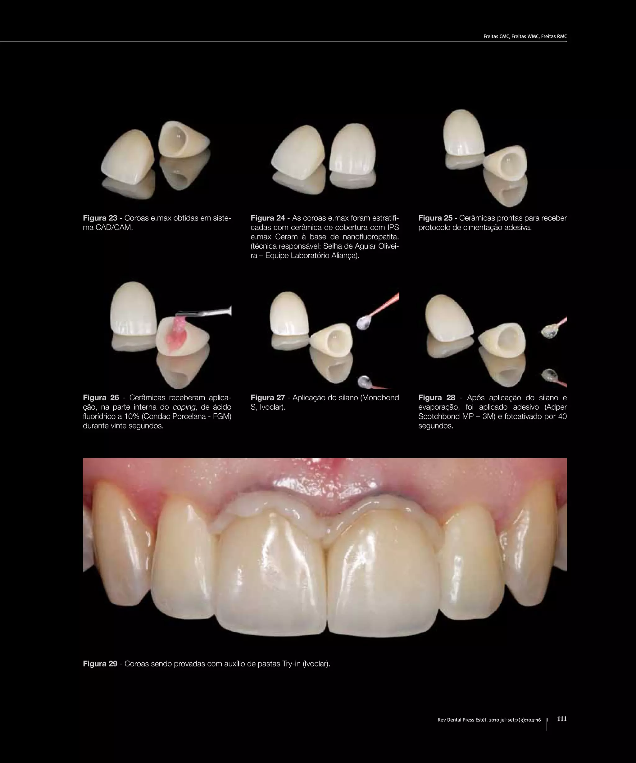 Freitas CMC, Freitas WMC, Freitas RMC
111Rev Dental Press Estét. 2010 jul-set;7(3):104-16
Figura 23 - Coroas e.max obtidas em siste-
ma CAD/CAM.
Figura 24 - As coroas e.max foram estratifi-
cadas com cerâmica de cobertura com IPS
e.max Ceram à base de nanofluoropatita.
(técnica responsável: Selha de Aguiar Olivei-
ra – Equipe Laboratório Aliança).
Figura 25 - Cerâmicas prontas para receber
protocolo de cimentação adesiva.
Figura 26 - Cerâmicas receberam aplica-
ção, na parte interna do coping, de ácido
fluorídrico a 10% (Condac Porcelana - FGM)
durante vinte segundos.
Figura 27 - Aplicação do silano (Monobond
S, Ivoclar).
Figura 28 - Após aplicação do silano e
evaporação, foi aplicado adesivo (Adper
Scotchbond MP – 3M) e fotoativado por 40
segundos.
Figura 29 - Coroas sendo provadas com auxílio de pastas Try-in (Ivoclar).
 