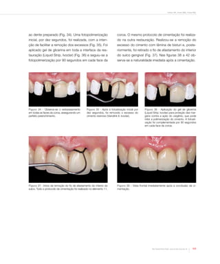 Freitas CMC, Freitas WMC, Freitas RMC
113Rev Dental Press Estét. 2010 jul-set;7(3):104-16
Figura 34 - Observa-se o extravasamento
em todas as faces da coroa, assegurando um
perfeito preenchimento.
Figura 35 - Após a fotoativação inicial por
dez segundos, foi removido o excesso do
cimento resinoso (Variolink II, Ivoclar).
Figura 36 - Aplicação do gel de glicerina
(Liquid Strip, Ivoclar) para proteção das mar-
gens contra a ação do oxigênio, que pode
inibir a polimerização do cimento. A fotoati-
vação foi complementada por 90 segundos
em cada face da coroa.
ao dente preparado (Fig. 34). Uma fotopolimerização
inicial, por dez segundos, foi realizada, com a inten-
ção de facilitar a remoção dos excessos (Fig. 35). Foi
aplicado gel de glicerina em toda a interface da res-
tauração (Liquid Strip, Ivoclar) (Fig. 36) e seguiu-se a
fotopolimerização por 90 segundos em cada face da
coroa. O mesmo protocolo de cimentação foi realiza-
do na outra restauração. Realizou-se a remoção do
excesso do cimento com lâmina de bisturi e, poste-
riormente, foi retirado o fio de afastamento do interior
do sulco gengival (Fig. 37). Nas figuras 38 a 42 ob-
serva-se a naturalidade imediata após a cimentação.
Figura 37 - Início da remoção do fio de afastamento do interior do
sulco. Todo o protocolo de cimentação foi realizado no elemento 11.
Figura 38 - Vista frontal imediatamente após a conclusão da ci-
mentação.
 