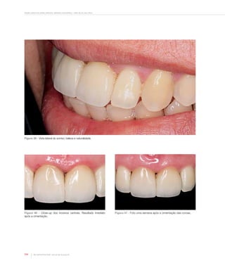Desafio estético em dentes anteriores: aplicando a biomimética – relato de um caso clínico
114 Rev Dental Press Estét. 2010 jul-set;7(3):104-16
Figura 39 - Vista lateral do sorriso: beleza e naturalidade.
Figura 40 - Close-up dos incisivos centrais. Resultado imediato
após a cimentação.
Figura 41 - Foto uma semana após a cimentação das coroas.
 