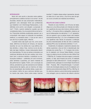 Desafio estético em dentes anteriores: aplicando a biomimética – relato de um caso clínico
106 Rev Dental Press Estét. 2010 jul-set;7(3):104-16
INTRODUÇÃO
Muito tem sido escrito e discutido sobre estética,
principalmente a estética da face e do sorriso3
. As leis
douradas, através de suas proporções matemáticas,
ganharam uma valorização frente aos profissionais
que trabalham com Odontologia Restauradora, e são
definidas como ponto a ser atingido: a proporção di-
vina4,5
. Porém, quando analisamos aqueles que são
considerados belos, há uma predominância da harmo-
nia. Proporções dentárias equilibradas parecem ser a
composição mais segura na obtenção de resultados
estéticos, ou resultados belos7
. O que se tem visto é
que não há um padrão rígido, inflexível.
O padrão talvez seja aquilo que nós, como socie-
dade, definimos de tempos em tempos, em épocas
recentes: ter ouro nos dentes era o que definia a be-
leza dentária, o status. Hoje, vivemos na era da abo-
lição das ligas metálicas, nossas restaurações devem
ser imperceptíveis. Por isso as resinas compostas e as
cerâmicas dentárias são tão bem aceitas, pois mime-
tizam bem a estrutura dentária e substituem as res-
taurações metálicas — preferidas, em outro momento,
pelos dentistas e pacientes, por serem materiais de
alta performance e rigidez. Porém, com a evolução da
ciência, percebemos que não precisamos de materiais
restauradores tão rígidos, pois os mesmos, em desa-
fios de exacerbação das tensões diárias, quase sem-
pre resistem melhor do que a estrutura dentária que,
na maioria das vezes, fratura sobre essas mesmas
tensões9
. O objetivo desse artigo é apresentar, através
do relato de um caso clínico, uma forma clara de apli-
car novos conceitos de materiais biomiméticos.
Relato do caso clínico
Paciente do sexo feminino, com 39 anos de idade,
dirigiu-se a uma clínica privada com intenção de melho-
rar a aparência dos seus dois incisivos centrais superio-
res (Fig. 1). No exame clínico e radiográfico, observou-se
que as restaurações nos elementos 11 e 21 apresenta-
vam-se rugosas e que os dentes haviam sido tratados
endodonticamente (Fig. 2, 3). Com a finalidade de obter
uma aparência mais natural, foi proposta a confecção
de pinos intrarradiculares de fibra de vidro e cerâmicas
adesivas IPS e.max nos elementos dentários 11 e 21.
Inicialmente, foi realizado o isolamento absoluto dos
dentes superiores e deu-se início à desobstrução das
entradas dos canais (Fig. 4 – 7). O preparo dos condu-
tos foi realizado com brocas Gates-Glidden e brocas
Largo do sistema de pino de fibra de vidro (White Post
– FGM) (Fig. 8). O preparo dos pinos seguiu o protocolo
padrão, ou seja, após limpeza dos pinos, foi realizada
aplicação do silano (Monobond S - Ivoclar), secagem e,
posteriormente, aplicação do bond (Adper Scotchbond
Multi - Purpose, 3M) e fotopolimerização. O procedi-
mento de cimentação adesiva do pino foi realizado com
sistema autocondicionante (Adper SE Plus, 3M) (Fig. 9).
Os sistemas adesivos autocondicionantes apresentam
uma vantagem, pois os mesmos não utilizam a técnica
Figura 1 - Sorriso inicial. Figura 2 - Incisivos centrais com restaura-
ções insatisfatórias em resinas compostas.
Figura 3 - Close up dos elementos 11 e 21.
 