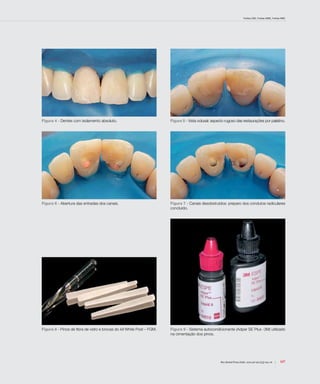 Freitas CMC, Freitas WMC, Freitas RMC
107Rev Dental Press Estét. 2010 jul-set;7(3):104-16
Figura 4 - Dentes com isolamento absoluto. Figura 5 - Vista oclusal: aspecto rugoso das restaurações por palatino.
Figura 6 - Abertura das entradas dos canais. Figura 7 - Canais desobstruídos: preparo dos condutos radiculares
concluído.
Figura 8 - Pinos de fibra de vidro e brocas do kit White Post – FGM. Figura 9 - Sistema autocondicionante (Adper SE Plus -3M) utilizado
na cimentação dos pinos.
 