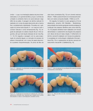 Desafio estético em dentes anteriores: aplicando a biomimética – relato de um caso clínico
108 Rev Dental Press Estét. 2010 jul-set;7(3):104-16
úmida — o que, na cimentação adesiva de pinos intrar-
radiculares, é um grande benefício, já que o controle da
umidade no ambiente interno do canal radicular é algo
difícil de se avaliar. A secagem da dentina radicular foi
realizada com cones de papel absorvente até a mesma
ficar completamente desidratada. Procedeu-se à apli-
cação do primer ácido (líquido A – cor rosa) em todo o
conduto radicular e coroa remanescente (Fig. 10), se-
guida da aplicação do adesivo (líquido B) por vinte se-
gundos, até que todo líquido deixasse de ser rosa (Fig.
11, 12). Em seguida, a secagem com ar, para evapo-
ração do solvente (água); e a remoção do excesso do
adesivo intrarradicular com cones de papel absorven-
te e posterior fotopolimerização. Os pinos de fibra de
vidro foram cimentados (Fig. 13) com cimento resinoso
(Allcem - FGM) e preenchimento do remanescente den-
tário com resina composta (Opallis - FGM) na cor B1.
Em seguida, foi inserido no sulco gengival um fio de
afastamento, tamanho 000 (Retraflex – Biodinâmica),
para proteção dos tecidos gengivais durante as etapas de
confecção dos preparos dentários para coroa total (Fig.
14). Os preparos dentários foram realizados com brocas
diamantadas e o acabamento dos ângulos dos preparos
com discos de lixa em baixa rotação. O refinamento do
término cervical foi realizado com brocas de acabamen-
to acopladas em contra-ângulo multiplicador (Koncept –
Kavo) (Fig. 15) e o acabamento do término cervical com
instrumento manual MA -2 (Safident) (Fig. 16).
Figura 10 - Aplicação do primer/ácido na estrutura dentária rema-
nescente e canal radicular.
Figura 11 - Início da aplicação do bond (líquido B) na estrutura dentária
remanescente e canal radicular.
Figura 12 - A aplicação do bond deve ser realizada até o total desa-
parecimento do líquido rosa, indicando que a reação entre o primer
ácido (líquido A, rosa) e o bond (líquido B, amarelo) ocorreu.
Figura 13 - Pinos de fibra de vidro cimentados (cimento resinoso
Allcem – FGM).
 