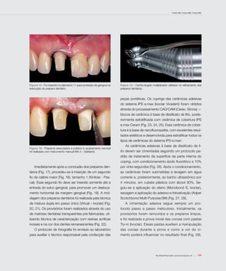 Freitas CMC, Freitas WMC, Freitas RMC
109Rev Dental Press Estét. 2010 jul-set;7(3):104-16
Figura 14 - Fio inserido no elemento 11 para proteção da gengiva na
execução do preparo dentário.
Figura 15 - Contra-ângulo multiplicador utilizado no refinamento dos
preparos dentários.
Figura 16 - Preparos executados e polidos (o acabamento cervical
foi realizado com instrumento manual MA 2 – Safident).
Imediatamente após a conclusão dos preparos den-
tários (Fig. 17), procedeu-se à inserção de um segundo
fio de calibre maior (Fig. 18), tamanho 1 (Kinitrax - Pas-
cal). Esse segundo fio deve ser inserido somente até a
entrada do sulco gengival, para promover um desloca-
mento horizontal da margem gengival (Fig. 19). A mol-
dagem dos preparos dentários foi realizada pela técnica
de mistura dupla em passo único (Virtual – Ivoclar) (Fig.
20, 21). Os provisórios foram realizados através do uso
de matrizes dentárias transparentes pré-fabricadas, uti-
lizando técnica de caracterização com resinas acrílicas
incisais e na cor dos dentes remanescentes (Fig. 22).
O protocolo de fotografia foi enviado ao laboratório
para auxiliar o técnico responsável pela confecção das
peças protéticas. Os copings das cerâmicas adesivas
do sistema IPS e.max (Ivoclar Vivadent) foram obtidos
através do processamento CAD/CAM (Cerec, Sirona) —
blocos de cerâmica à base de dissilicato de lítio, poste-
riormente estratificada com cerâmica de cobertura IPS
e.max Ceram (Fig. 23, 24, 25). Essa cerâmica de cober-
tura é à base de nanofluoropatita, com excelentes resul-
tados estéticos e desenvolvida para estratificar todos os
tipos de cerâmicas do sistema IPS e.max7
.
As cerâmicas adesivas à base de dissilicato de lí-
tio devem ser cimentadas seguindo um protocolo pa-
drão de tratamento da superfície da parte interna do
coping, com condicionamento ácido fluorídrico a 10%
por vinte segundos (Fig. 26). Após o condicionamento,
as cerâmicas foram submetidas à lavagem em água
corrente e, posteriormente, ao banho ultrassônico por
4 minutos, em cubeta plástica com álcool 90%. Se-
guiu-se a aplicação do silano (Monobond S, Ivoclar),
secagem e aplicação do adesivo e fotoativação (Adper
Scotchbond Multi-Purpose/3M) (Fig. 27, 28).
A cimentação adesiva segue sempre um pro-
tocolo passo a passo meticuloso. Inicialmente, os
provisórios foram removidos e os preparos limpos,
e foi realizada a prova inicial das coroas com pastas
Try-in (Ivoclar). Essas pastas auxiliam a manipulação
das coroas durante a prova e como a cor do ci-
mento poderá influenciar no resultado final (Fig. 29).
 