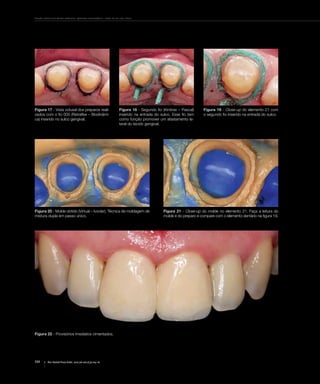 Desafio estético em dentes anteriores: aplicando a biomimética – relato de um caso clínico
110 Rev Dental Press Estét. 2010 jul-set;7(3):104-16
Figura 17 - Vista oclusal dos preparos reali-
zados com o fio 000 (Retraflex – Biodinâmi-
ca) inserido no sulco gengival.
Figura 18 - Segundo fio (Kinitrax – Pascal)
inserido na entrada do sulco. Esse fio tem
como função promover um afastamento la-
teral do tecido gengival.
Figura 19 - Close-up do elemento 21 com
o segundo fio inserido na entrada do sulco.
Figura 20 - Molde obtido (Virtual – Ivoclar). Técnica de moldagem de
mistura dupla em passo único.
Figura 22 - Provisórios imediatos cimentados.
Figura 21 - Close-up do molde no elemento 21. Faça a leitura do
molde e do preparo e compare com o elemento dentário na figura 19.
 