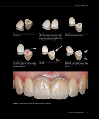 Freitas CMC, Freitas WMC, Freitas RMC
111Rev Dental Press Estét. 2010 jul-set;7(3):104-16
Figura 23 - Coroas e.max obtidas em siste-
ma CAD/CAM.
Figura 24 - As coroas e.max foram estratifi-
cadas com cerâmica de cobertura com IPS
e.max Ceram à base de nanofluoropatita.
(técnica responsável: Selha de Aguiar Olivei-
ra – Equipe Laboratório Aliança).
Figura 25 - Cerâmicas prontas para receber
protocolo de cimentação adesiva.
Figura 26 - Cerâmicas receberam aplica-
ção, na parte interna do coping, de ácido
fluorídrico a 10% (Condac Porcelana - FGM)
durante vinte segundos.
Figura 27 - Aplicação do silano (Monobond
S, Ivoclar).
Figura 28 - Após aplicação do silano e
evaporação, foi aplicado adesivo (Adper
Scotchbond MP – 3M) e fotoativado por 40
segundos.
Figura 29 - Coroas sendo provadas com auxílio de pastas Try-in (Ivoclar).
 