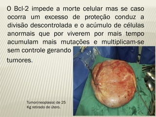 O Bcl-2 impede a morte celular mas se caso ocorra um excesso de proteção conduz a divisão descontrolada e o acúmulo de células anormais que por viverem por mais tempo acumulam mais mutações e multiplicam-se sem controle gerando 
tumores. 
Tumor(neoplasia) de 25 Kg retirado de útero.  