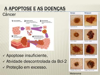 A APOPTOSE E AS DOENÇAS 
Câncer 
Apoptose insuficiente, 
Atvidade descontrolada da Bcl-2 
Proteção em excesso. 
Melanoma  
