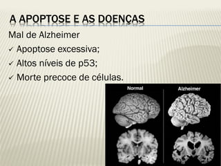 A APOPTOSE E AS DOENÇAS 
Mal de Alzheimer 
Apoptose excessiva; 
Altos níveis de p53; 
Morte precoce de células. 
 