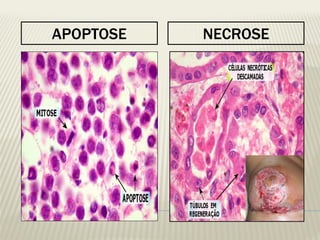 APOPTOSE 
NECROSE  