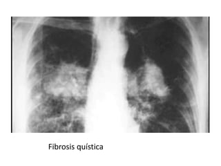 Fibrosis quística
 
