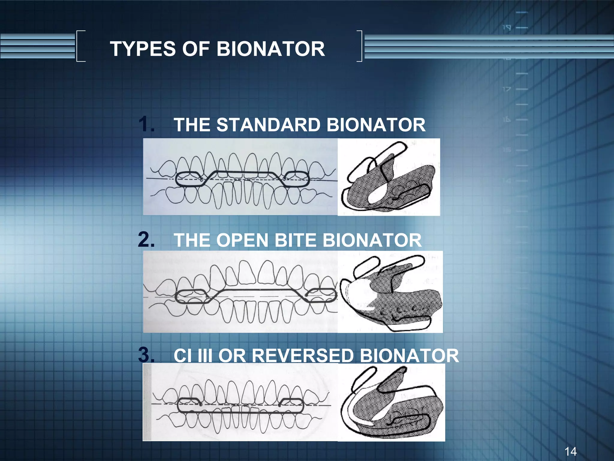 TYPES OF BIONATOR


  1. THE STANDARD BIONATOR




  2. THE OPEN BITE BIONATOR




  3. CI III OR REVERSED BIONATOR



                                   14
 