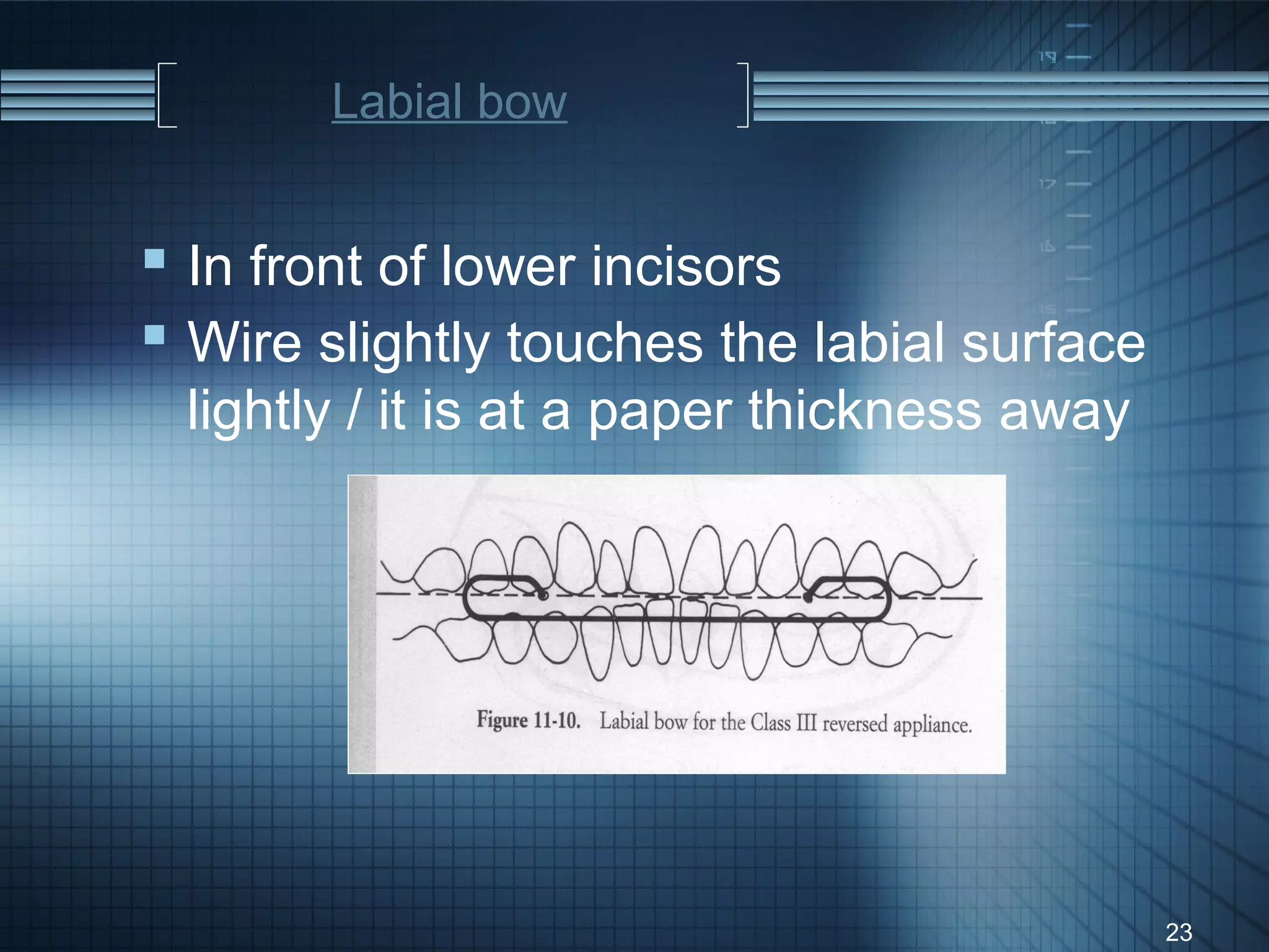 Labial bow


 In front of lower incisors
 Wire slightly touches the labial surface
 lightly / it is at a paper thickness away




                                             23
 