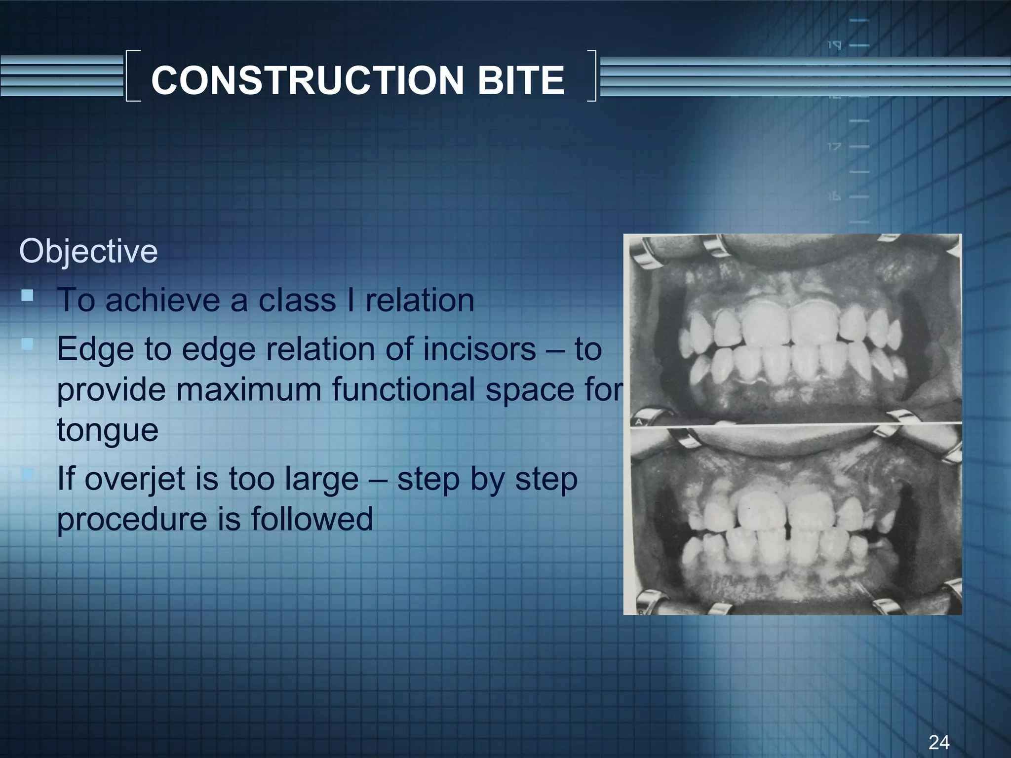 CONSTRUCTION BITE



Objective
 To achieve a cIass I relation
 Edge to edge relation of incisors – to
  provide maximum functional space for
  tongue
 If overjet is too large – step by step
  procedure is followed




                                           24
 