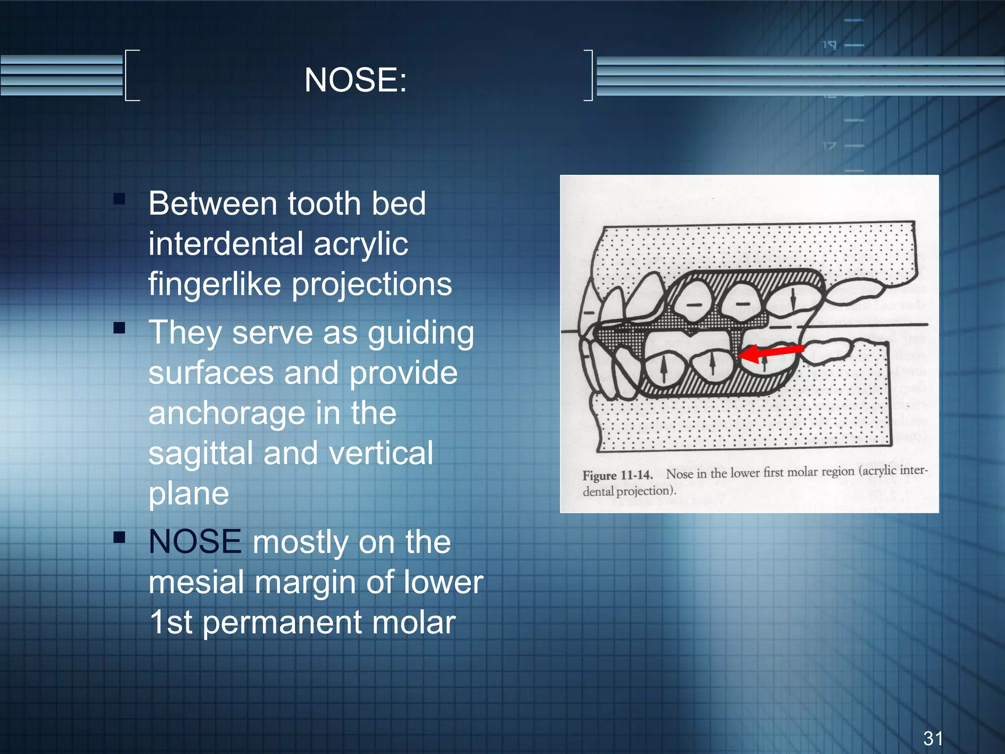 NOSE:


 Between tooth bed
  interdental acrylic
  fingerlike projections
 They serve as guiding
  surfaces and provide
  anchorage in the
  sagittal and vertical
  plane
 NOSE mostly on the
  mesial margin of lower
  1st permanent molar


                           31
 