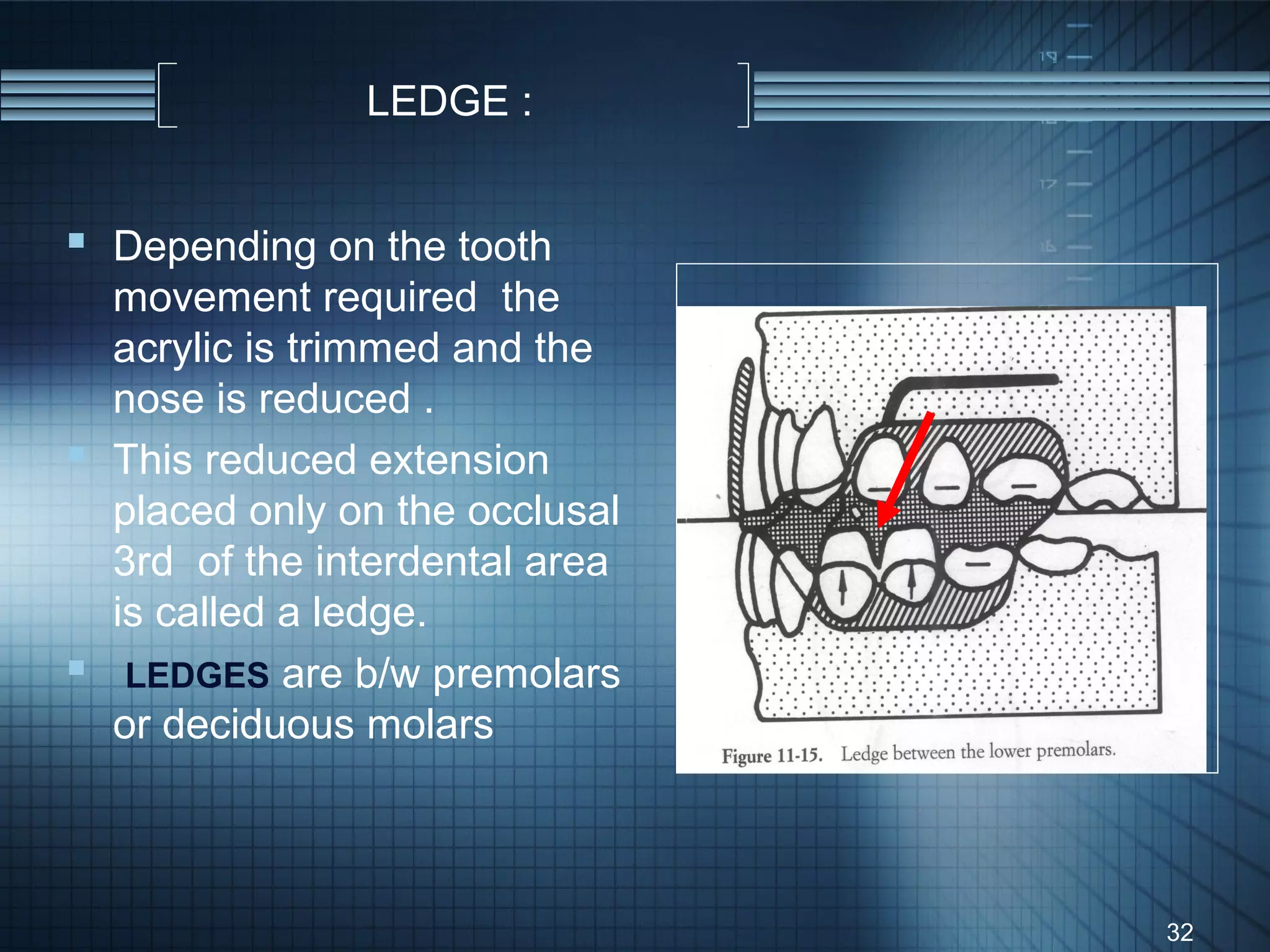 LEDGE :


 Depending on the tooth
  movement required the
  acrylic is trimmed and the
  nose is reduced .
 This reduced extension
  placed only on the occlusal
  3rd of the interdental area
  is called a ledge.
 LEDGES are b/w premolars
  or deciduous molars



                                32
 