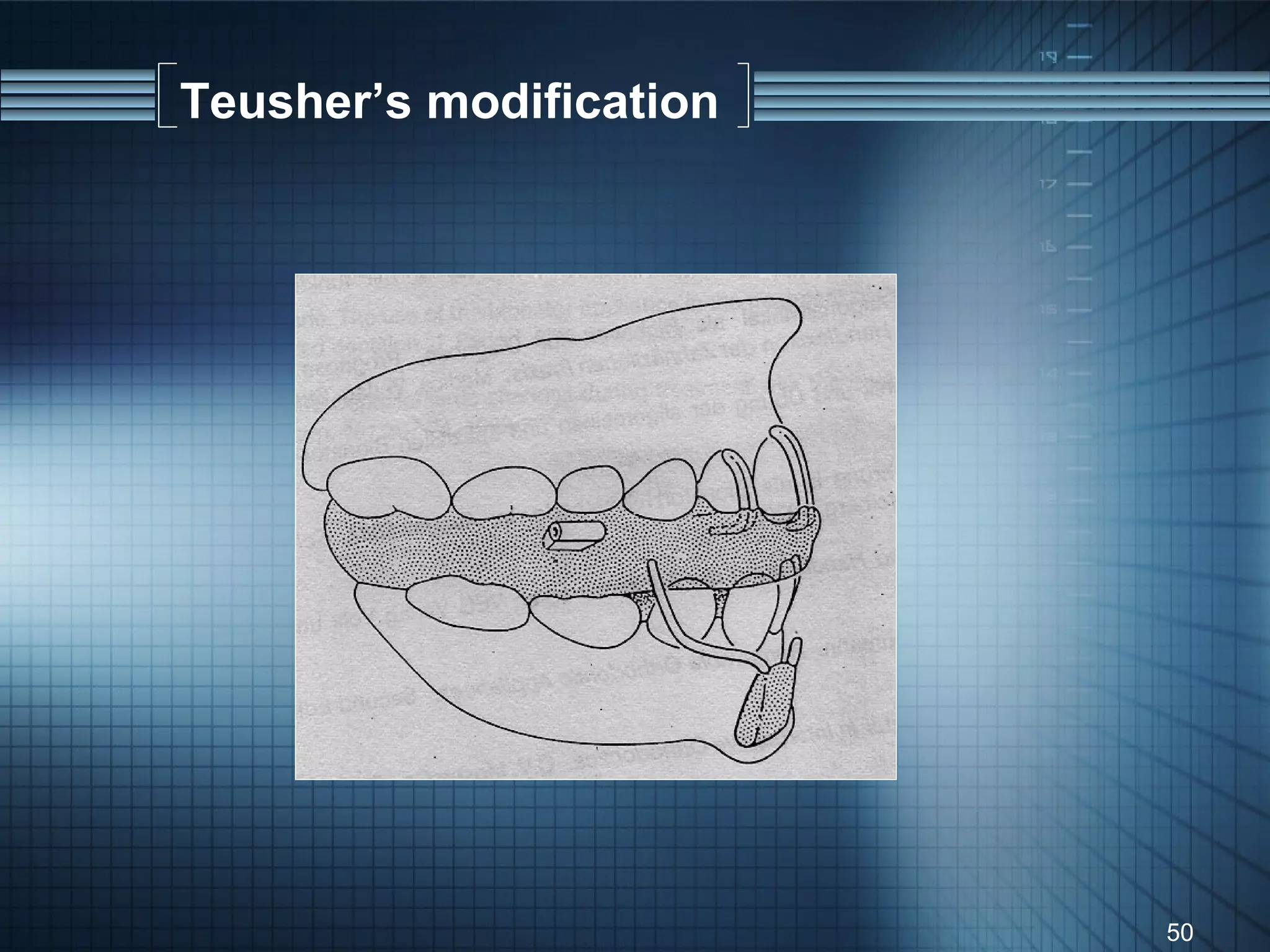 Teusher’s modification




                         50
 