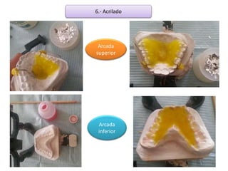 6.- Acrilado
Arcada
superior
Arcada
inferior
 