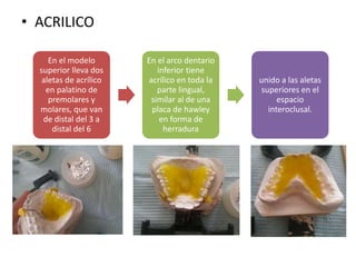 • ACRILICO
En el modelo
superior lleva dos
aletas de acrílico
en palatino de
premolares y
molares, que van
de distal del 3 a
distal del 6
En el arco dentario
inferior tiene
acrílico en toda la
parte lingual,
similar al de una
placa de hawley
en forma de
herradura
unido a las aletas
superiores en el
espacio
interoclusal.
 