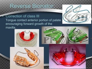 Reverse Bionator:
• Correction of class III
Tongue contact anterior portion of palate ,
encouraging forward growth of the
maxilla.
40
 