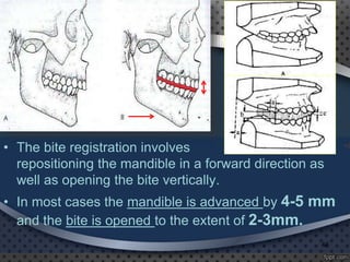 • The bite registration involves
repositioning the mandible in a forward direction as
well as opening the bite vertically.
• In most cases the mandible is advanced by 4-5 mm
and the bite is opened to the extent of 2-3mm.
46
 