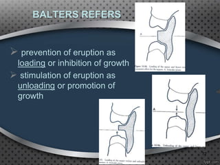 BALTERS REFERS
77
 prevention of eruption as
loading or inhibition of growth
 stimulation of eruption as
unloading or promotion of
growth
 