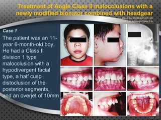 Treatment of Angle Class II malocclusions with a
newly modified bionator combined with headgear
J Dent Sci 2009;4(2):87−95
Yen-Chun Lin, Hsiang-Chien Lin
Case 1
The patient was an 11-
year 6-month-old boy.
He had a Class II
division 1 type
malocclusion with a
hypodivergent facial
type, a half cusp
distoclusion of the
posterior segments,
and an overjet of 10mm
89
 