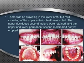 • There was no crowding in the lower arch, but mild
crowding of the upper anterior teeth was noted. The
upper deciduous second molars were retained, and the
upper and lower permanent second molars had not yet
erupted.
90
 