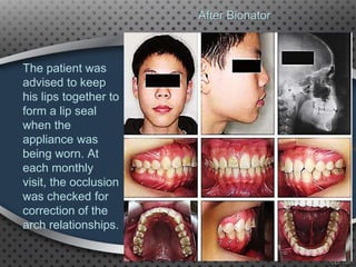 After Bionator
The patient was
advised to keep
his lips together to
form a lip seal
when the
appliance was
being worn. At
each monthly
visit, the occlusion
was checked for
correction of the
arch relationships.
93
 